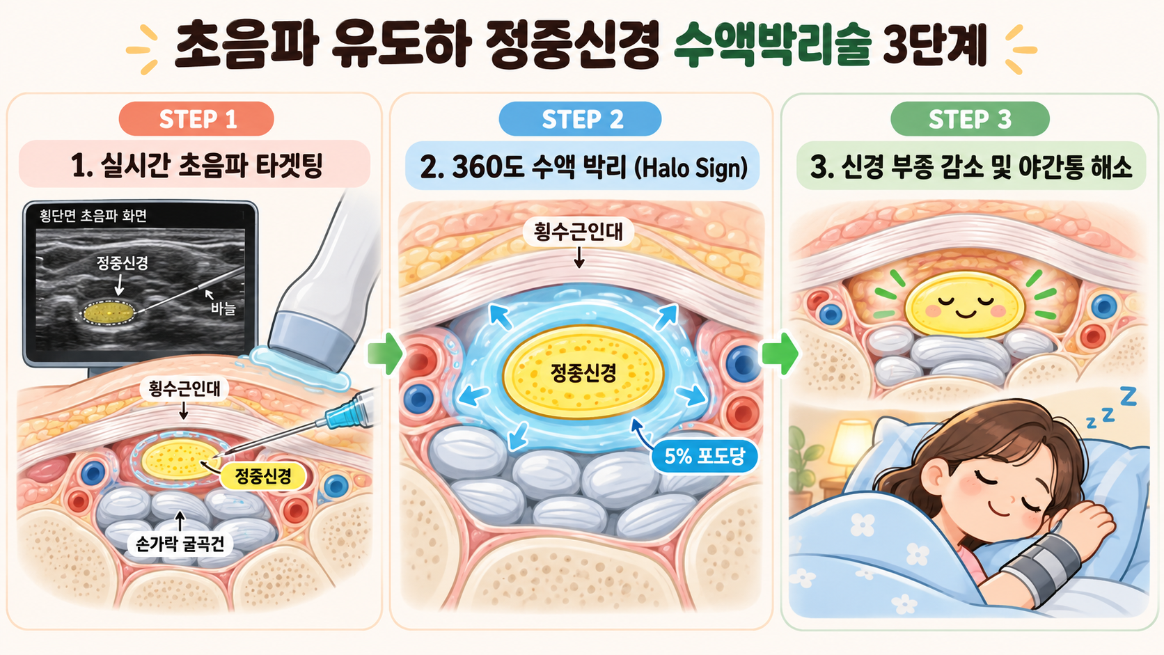초음파 유도하 정중신경 수액박리술 3단계 치료 원리