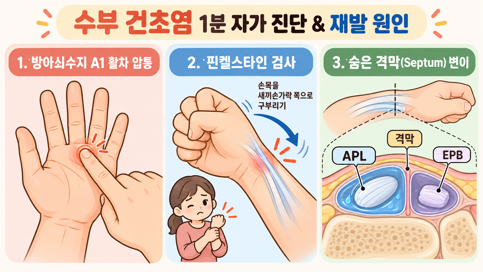 손가락 손목 건초염 1분 자가 진단 및 드케르뱅 격막 변이