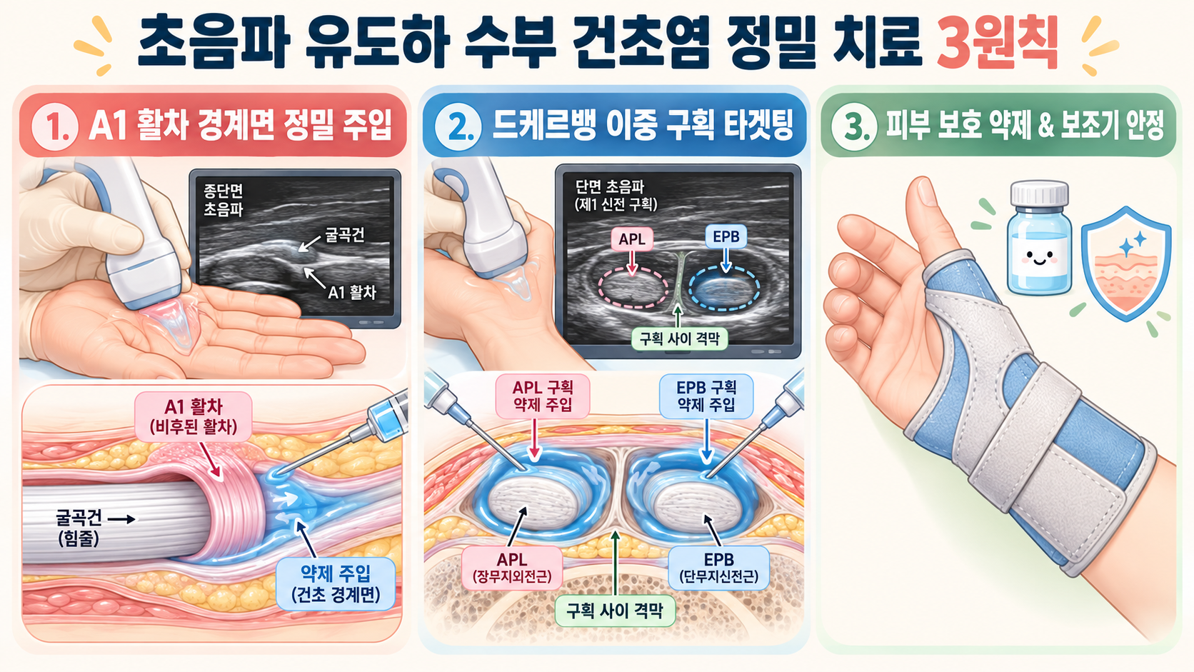 초음파 유도하 수부 건초염 정밀 비수술 치료 프로토콜