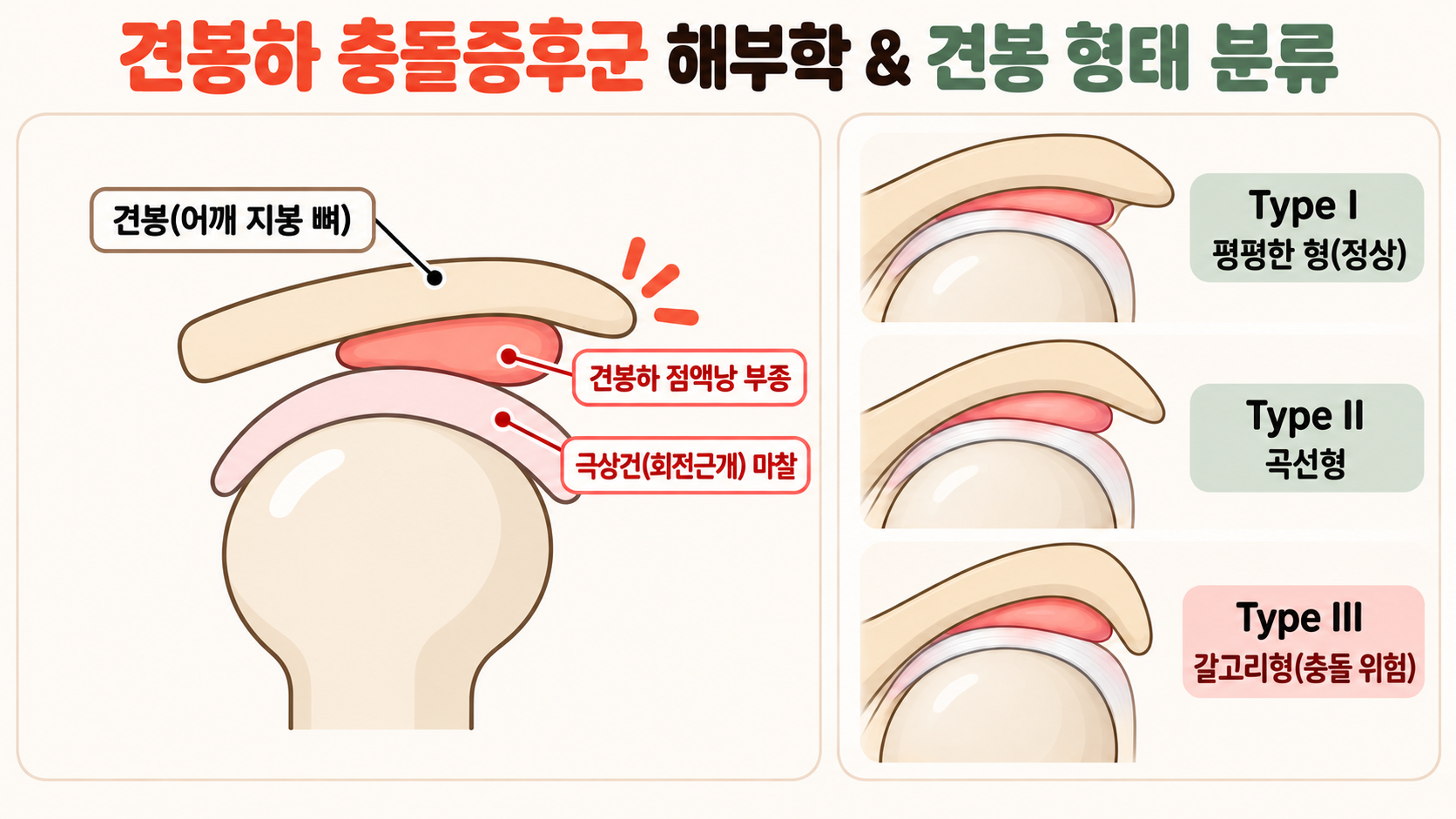 견봉하 공간 협소와 견봉 형태에 따른 점액낭 및 회전근개 충돌 기전